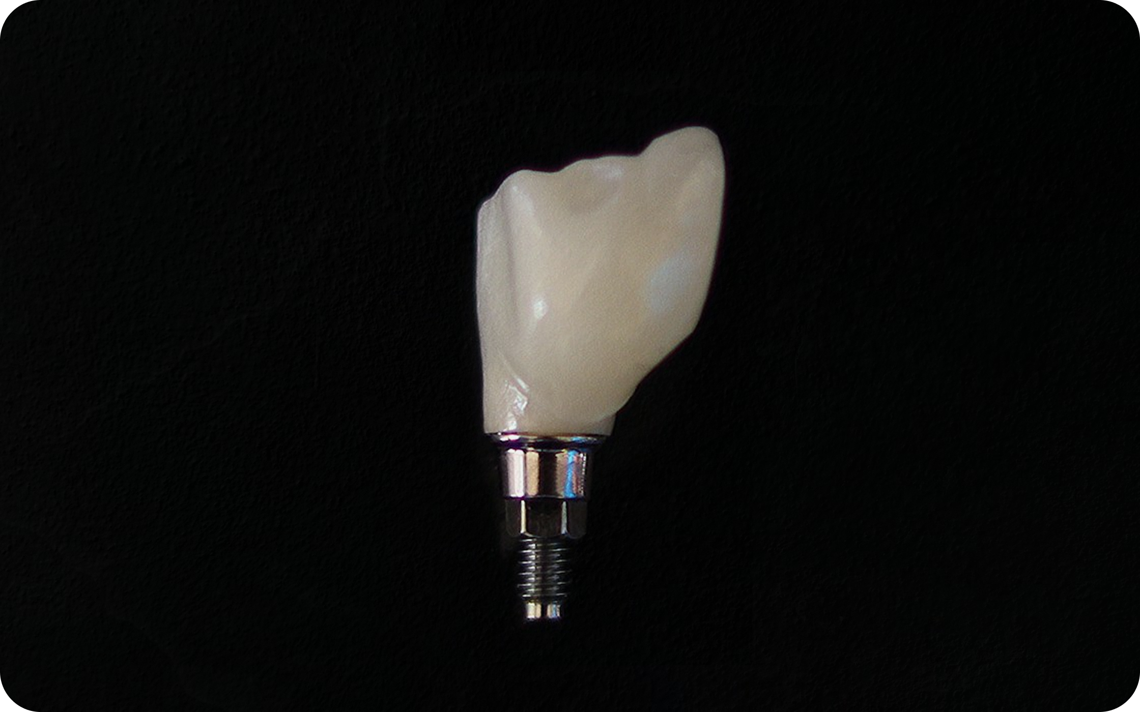 Glass-Ceramic Restorations